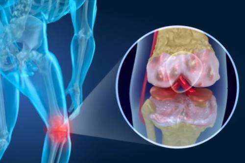 Artroscopía de rodilla y hombro