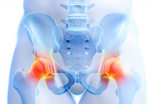 Tratamiento de artrosis de cadera y rodilla