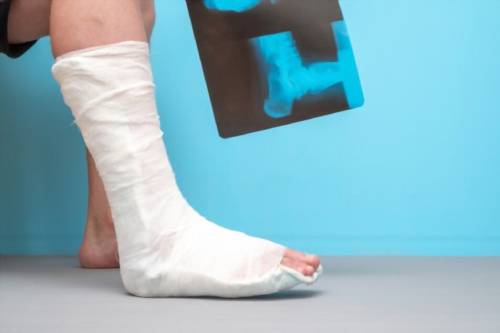 Tratamiento de fracturas
