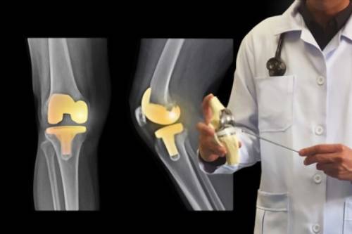 Prótesis de rodilla y hombro